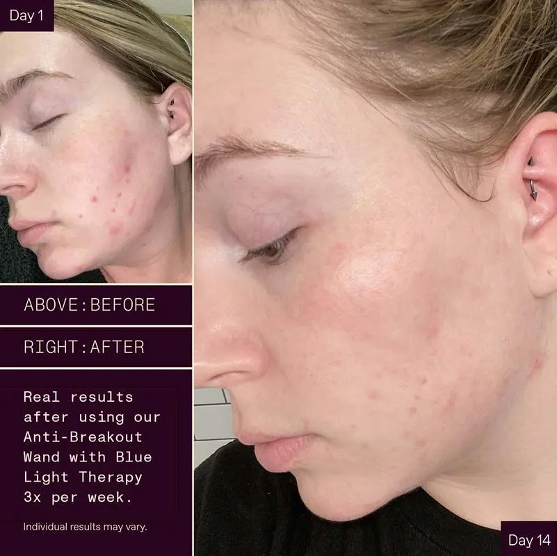 Bye Acne: 3 Minute Light Therapy Spot Treatment - Image 4