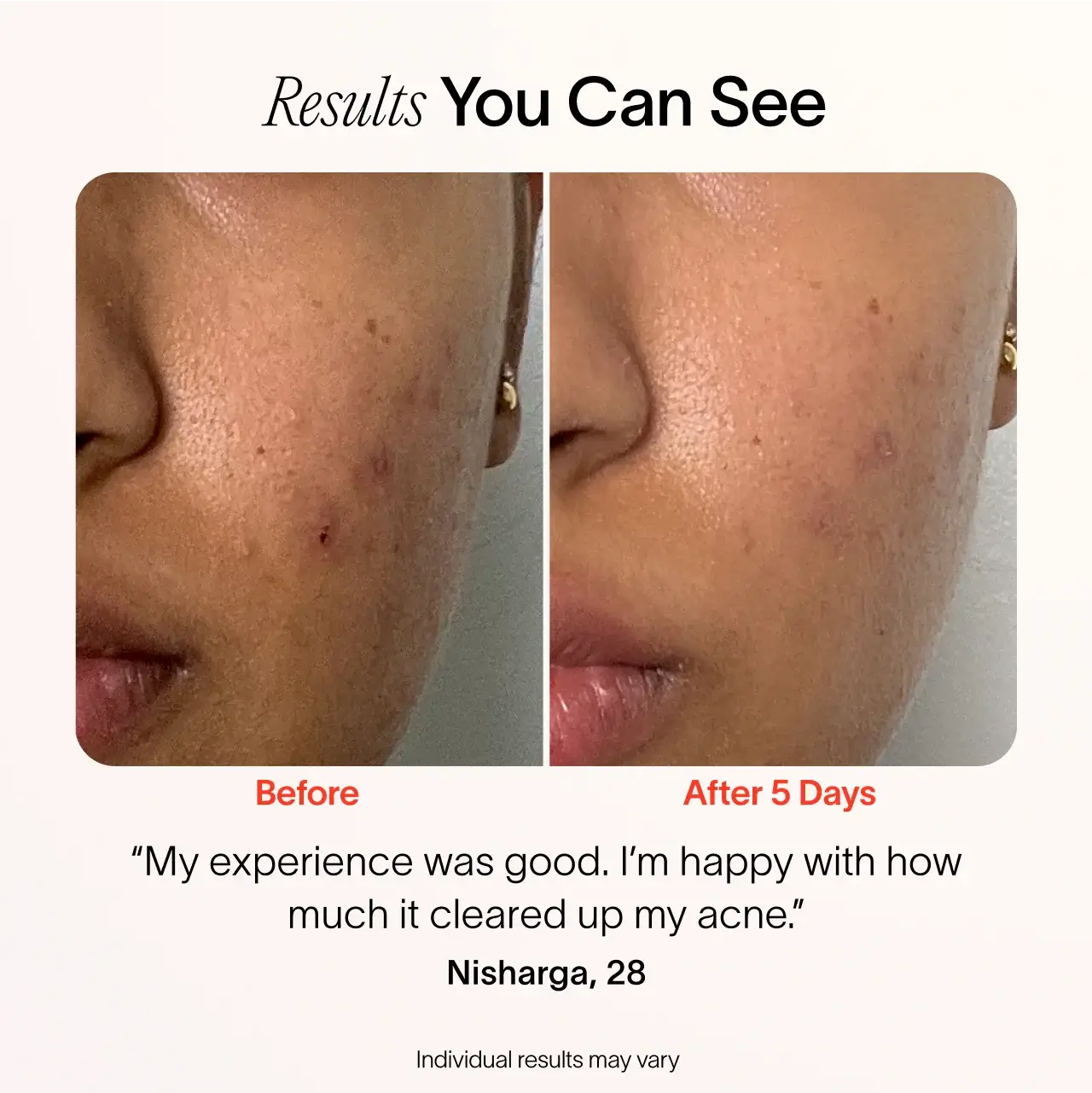 Bye Acne: 3-Minute Pimple Spot Treatment - Image 5