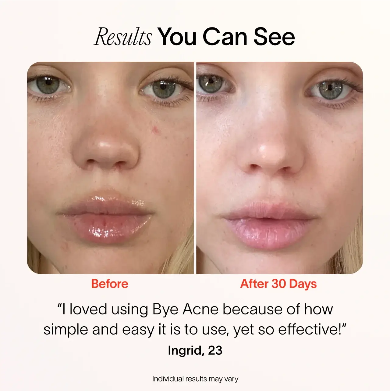Bye Acne: 3-Minute Pimple Spot Treatment - Image 6
